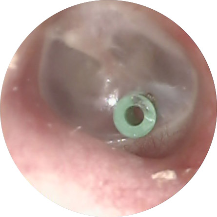 Image result for ventilation tube ear