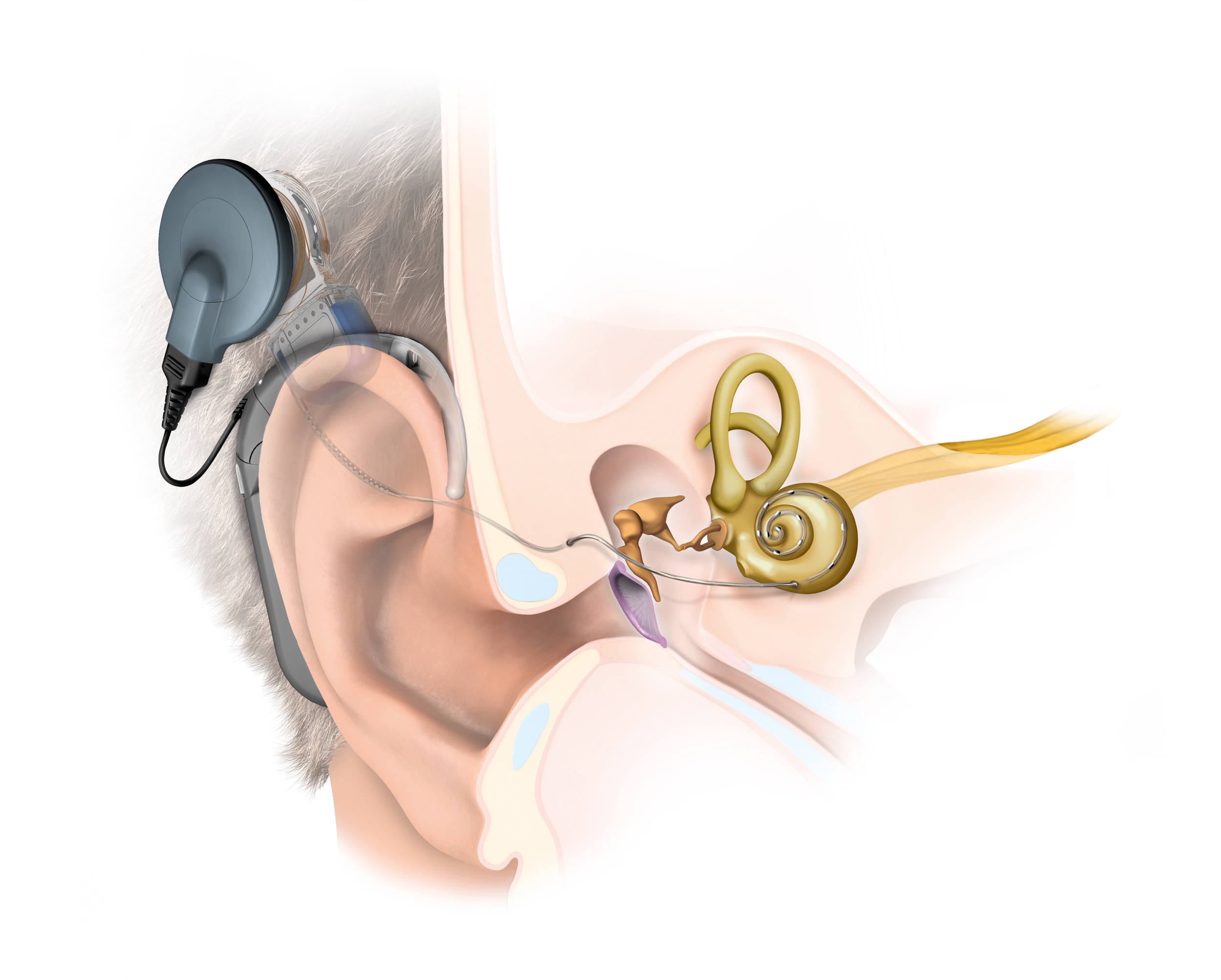Cochlear Implants Adelaide Specialist ENT Surgeon Paul Varley ENT