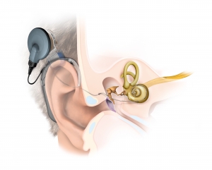 Cochlear Implants and Bone Conduction Implants
