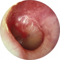 Recurrent middle ear infections