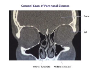 Turbinate surgery